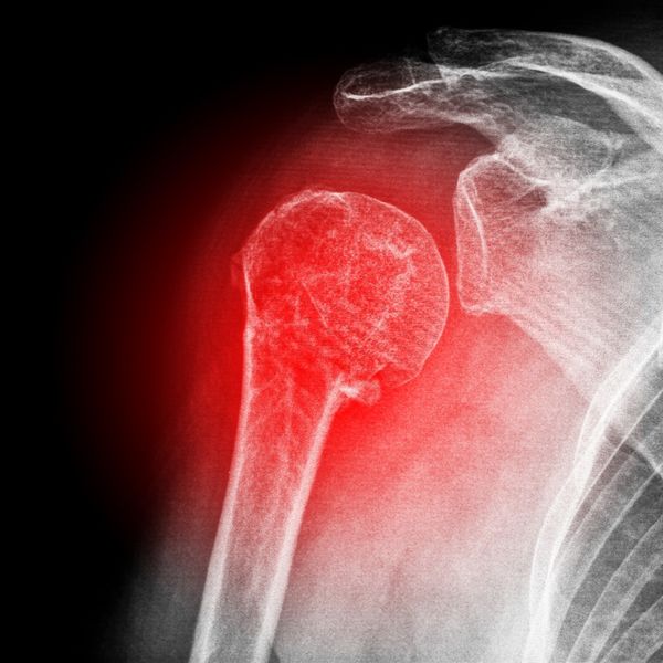 西宮市で野球肩に専門的な整体院。タブチ神経整体院